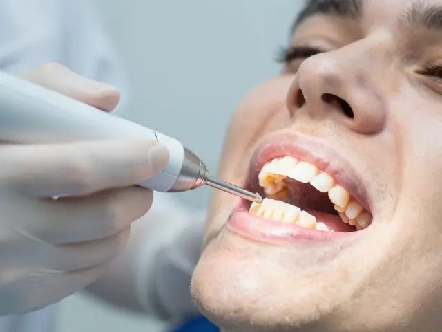 Odstranění zubního kamene: Jak získat zdravý a krásný úsměv